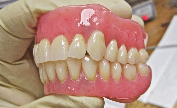 一般的な保険の入れ歯1